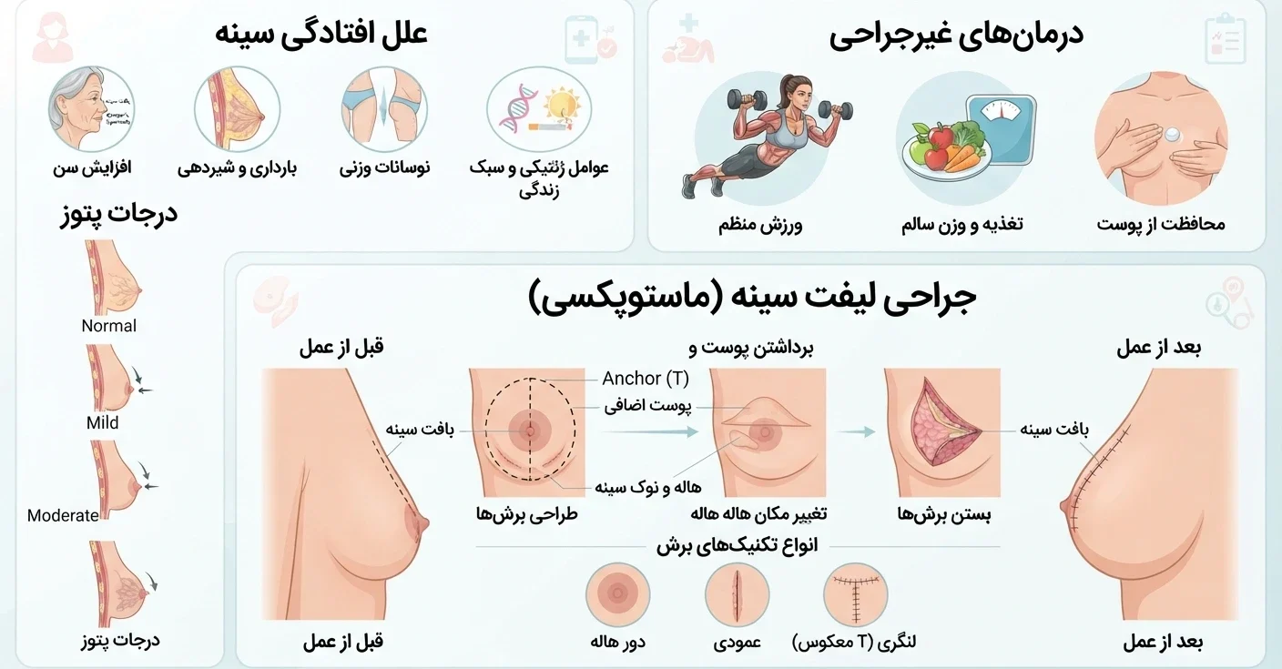 ماموپلاستی | افتادگی سینه 